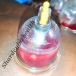 shardeybizhealth cupping photos (blood segmentation)