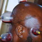 shardeybizhealth (Head Cupping)